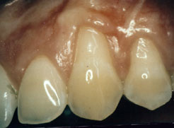 teeth before gum grafting