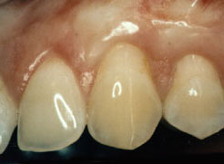 teeth after gum grafting