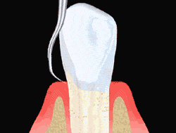 Tooth Scaling